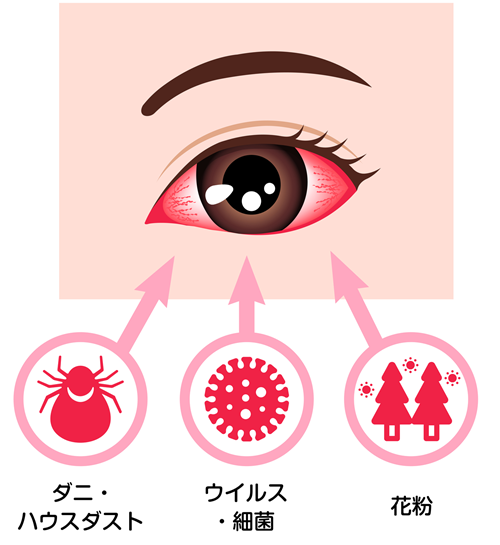片目だけの場合もある？結膜炎とは