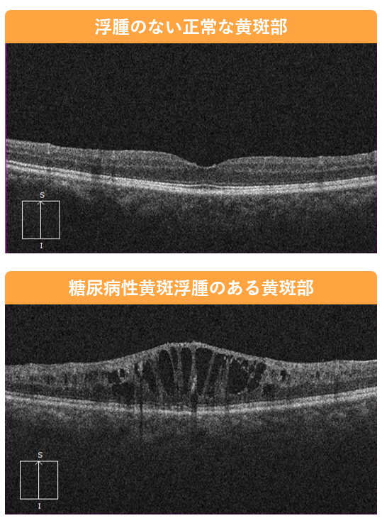 正常時と黄斑浮腫の比較