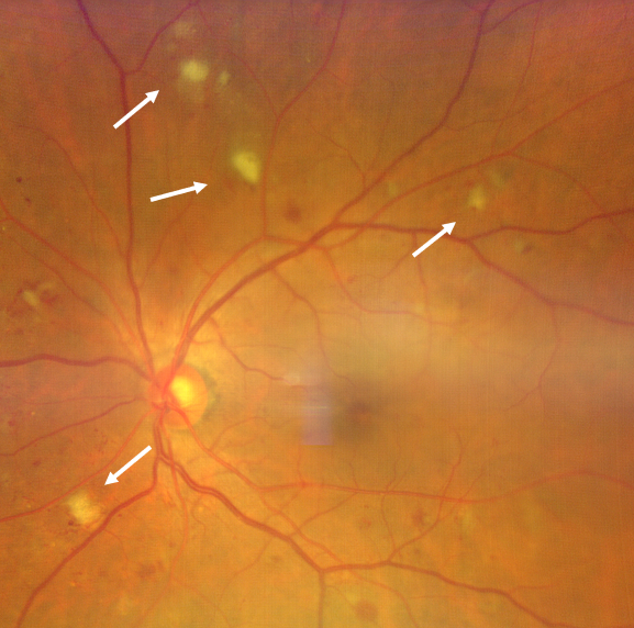 増殖前網膜症の軟性白斑
