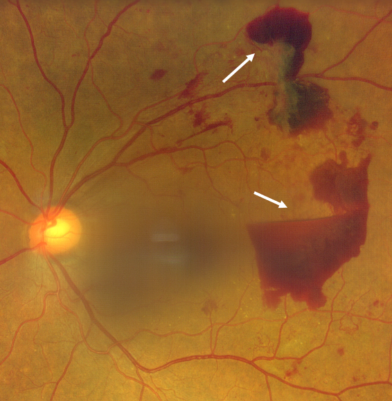 増殖糖尿病網膜症
